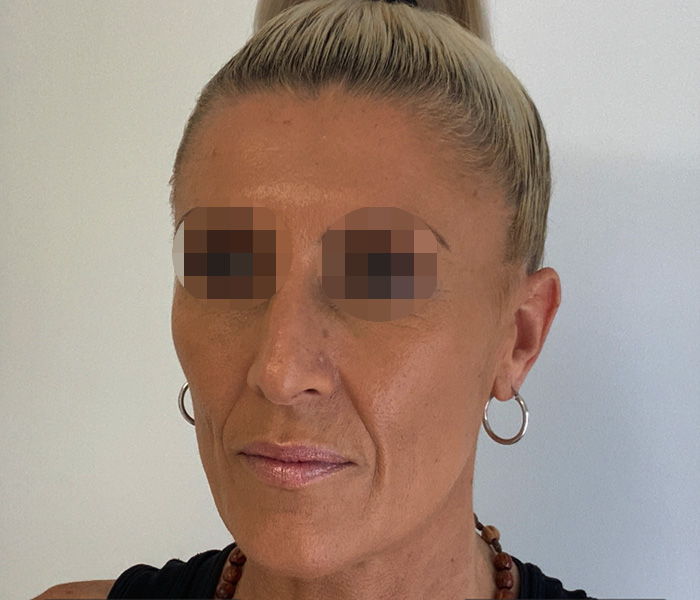 Sculptra-Side-After-new