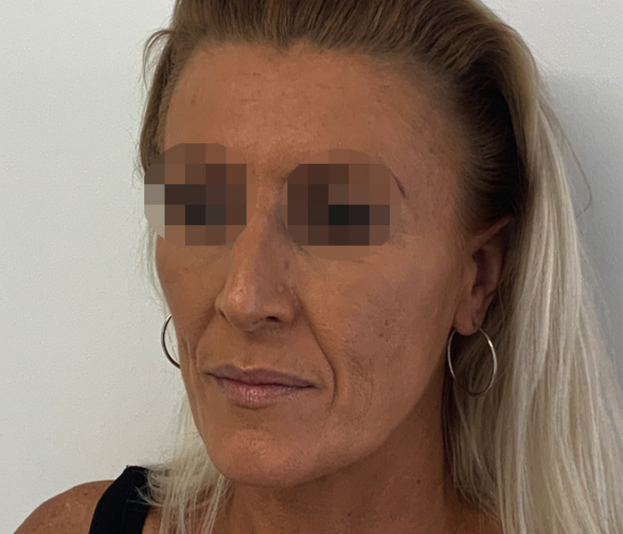 Sculptra-Side-Before-new